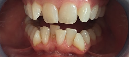Before Invisalign Treatment Reading Smiles Before Invisalign Treatment Reading Smiles