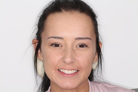 After Invisalign Treatment Reading Smiles After Invisalign Treatment Reading Smiles