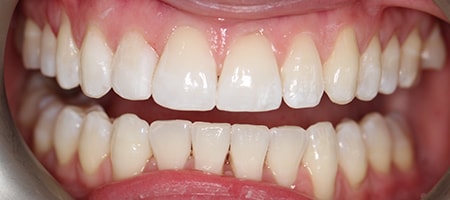 After Invisalign Treatment Reading Smiles After Invisalign Treatment Reading Smiles