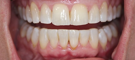 After Invisalign Treatment Reading Smiles After Invisalign Treatment Reading Smiles