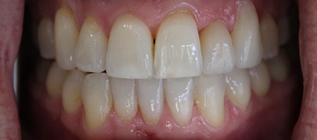 After Invisalign Treatment Reading Smiles After Invisalign Treatment Reading Smiles