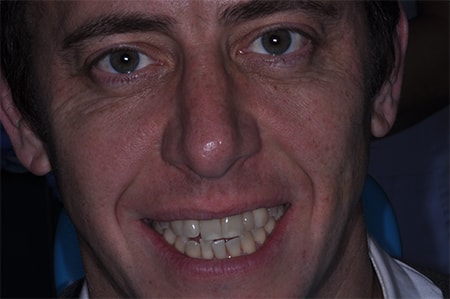 Before Invisalign Treatment Reading Smiles Before Invisalign Treatment Reading Smiles