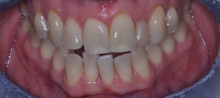 Before Invisalign Treatment Reading Smiles Before Invisalign Treatment Reading Smiles
