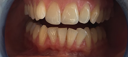 Before Invisalign Treatment Reading Smiles Before Invisalign Treatment Reading Smiles