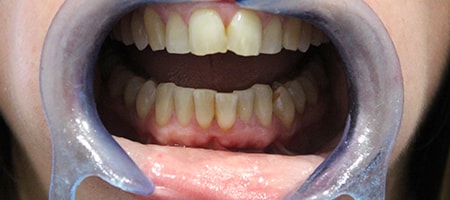 Before Invisalign Treatment Reading Smiles Before Invisalign Treatment Reading Smiles