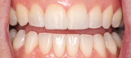 After Invisalign Treatment Reading Smiles After Invisalign Treatment Reading Smiles