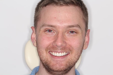 After Invisalign Treatment Reading Smiles After Invisalign Treatment Reading Smiles