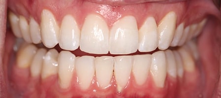 After Invisalign Treatment Reading Smiles After Invisalign Treatment Reading Smiles