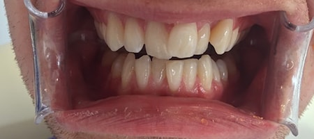 Before Invisalign Treatment Reading Smiles Before Invisalign Treatment Reading Smiles