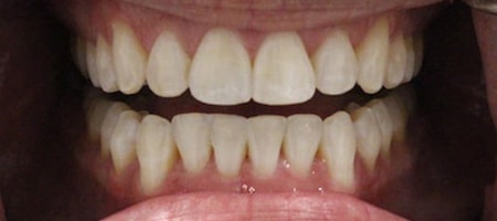 After Invisalign Treatment Reading Smiles After Invisalign Treatment Reading Smiles
