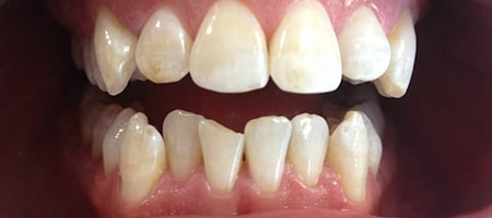 Before Invisalign Treatment Reading Smiles Before Invisalign Treatment Reading Smiles