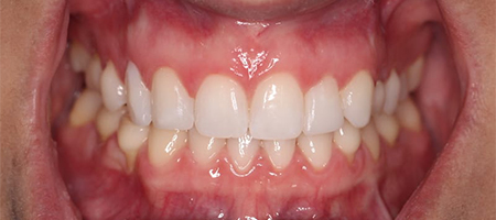 After Invisalign Treatment Reading Smiles After Invisalign Treatment Reading Smiles