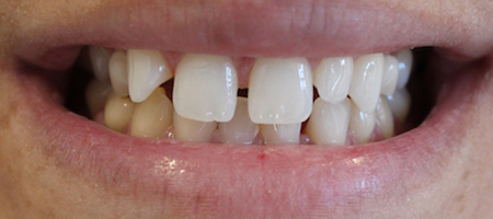 Before Invisalign Treatment Reading Smiles Before Invisalign Treatment Reading Smiles