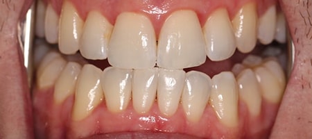 After Invisalign Treatment Reading Smiles After Invisalign Treatment Reading Smiles