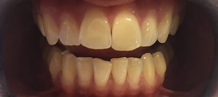 Before Invisalign Treatment Reading Smiles Before Invisalign Treatment Reading Smiles