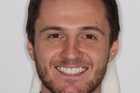 After Invisalign Treatment Reading Smiles After Invisalign Treatment Reading Smiles