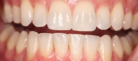 After Invisalign Treatment Reading Smiles After Invisalign Treatment Reading Smiles