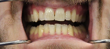 Before Invisalign Treatment Reading Smiles Before Invisalign Treatment Reading Smiles