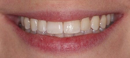 After Invisalign Treatment Reading Smiles After Invisalign Treatment Reading Smiles