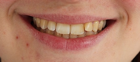 Before Invisalign Treatment Reading Smiles Before Invisalign Treatment Reading Smiles