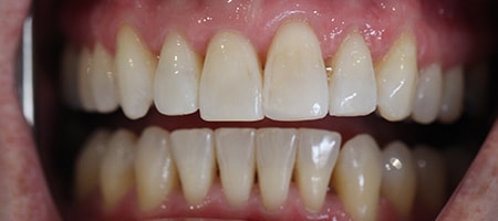 After Invisalign Treatment Reading Smiles After Invisalign Treatment Reading Smiles