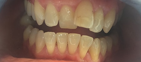 Before Invisalign Treatment Reading Smiles Before Invisalign Treatment Reading Smiles
