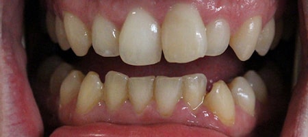 Before Invisalign Treatment Reading Smiles Before Invisalign Treatment Reading Smiles
