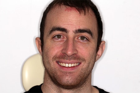 After Invisalign Treatment Reading Smiles After Invisalign Treatment Reading Smiles