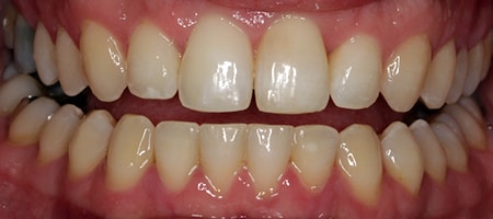 After Invisalign Treatment Reading Smiles After Invisalign Treatment Reading Smiles