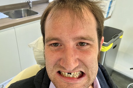 Before Invisalign Treatment Reading Smiles Before Invisalign Treatment Reading Smiles