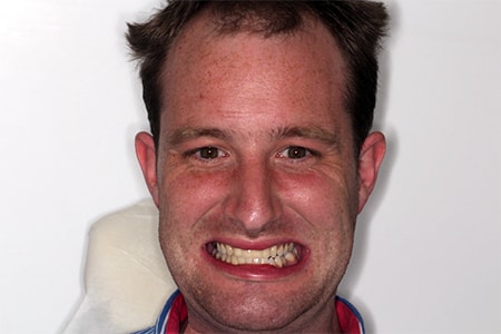 After Invisalign Treatment Reading Smiles After Invisalign Treatment Reading Smiles