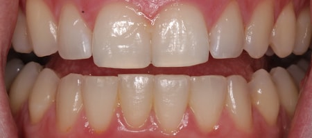 After Invisalign Treatment Reading Smiles After Invisalign Treatment Reading Smiles