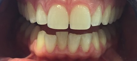 Before Invisalign Treatment Reading Smiles Before Invisalign Treatment Reading Smiles