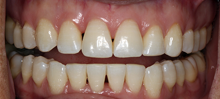 After Invisalign Treatment Reading Smiles After Invisalign Treatment Reading Smiles