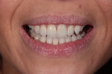 After Smile Makeover Treatment Reading Smiles