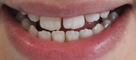 Before Invisalign Treatment Reading Smiles Before Invisalign Treatment Reading Smiles