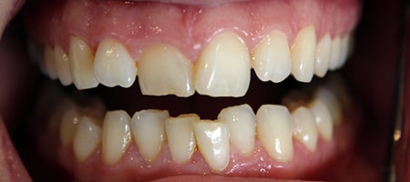 Before Invisalign Treatment Reading Smiles Before Invisalign Treatment Reading Smiles