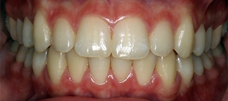 After Invisalign Treatment Reading Smiles After Invisalign Treatment Reading Smiles