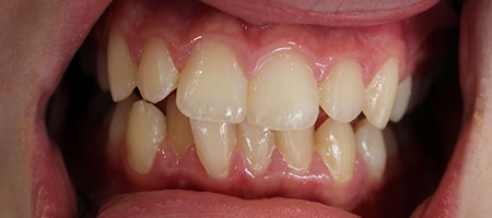 Before Invisalign Treatment Reading Smiles Before Invisalign Treatment Reading Smiles