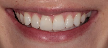 After Invisalign Treatment Reading Smiles