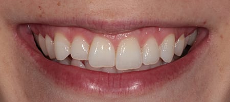 Composite Bonding Cases