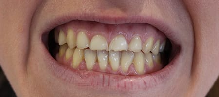 Before veneers Treatment Reading Smiles