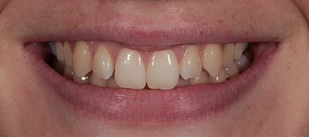 Composite Bonding Cases
